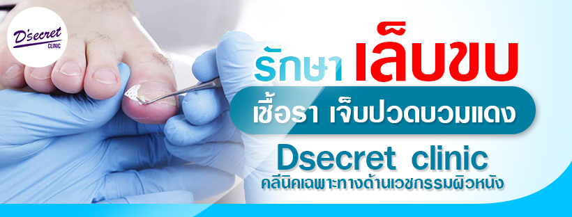 รักษาเล็บขบ - D'Secret Clinic - D'Secret Clinic
